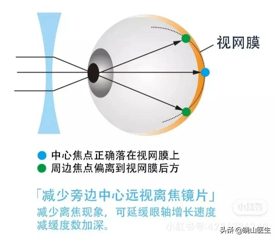大夫不建議使用星趣控鏡片