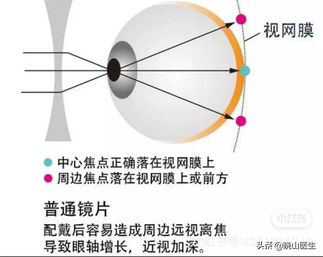 大夫不建議使用星趣控鏡片