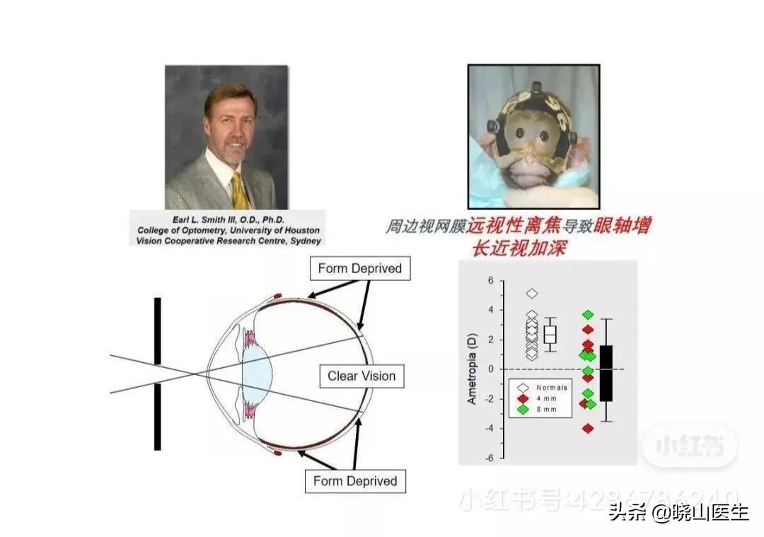 大夫不建議使用星趣控鏡片