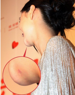 為什么很多人下巴左下角長痣(為什么很多人下巴都有疤)