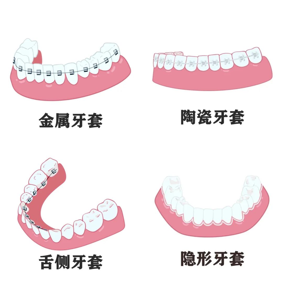 牙套的種類(lèi)和價(jià)格(牙套價(jià)格表圖片)