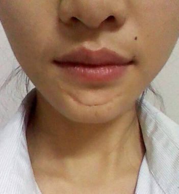 為什么很多人下巴左下角長痣(為什么很多人下巴都有疤)