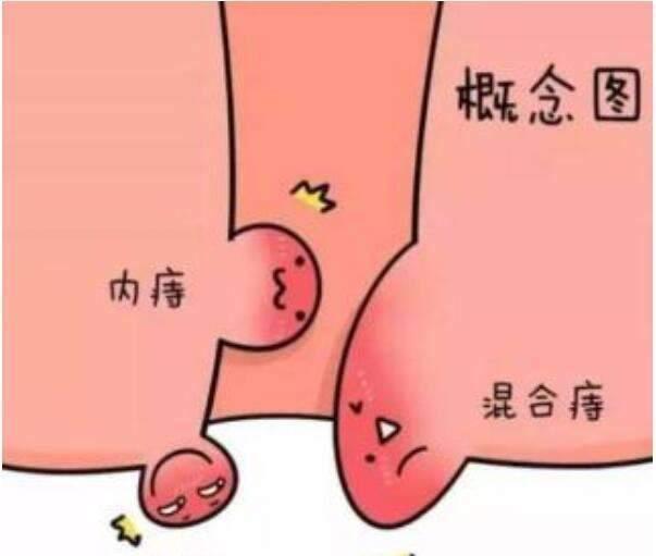 十女九痔是真的嗎(女人長痔瘡怎么治)