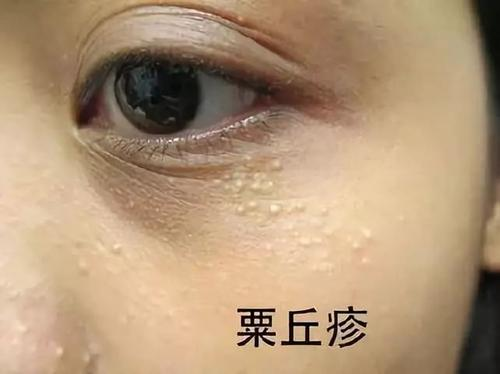 臉上長了好多小顆粒但又不像痘痘（教你怎樣去掉）